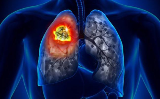 các dấu hiệu cảnh báo bệnh ung thư phổi thường bị bỏ qua