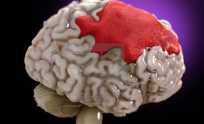 nguyên nhân, triệu chứng và cách điều trị xuất huyết não